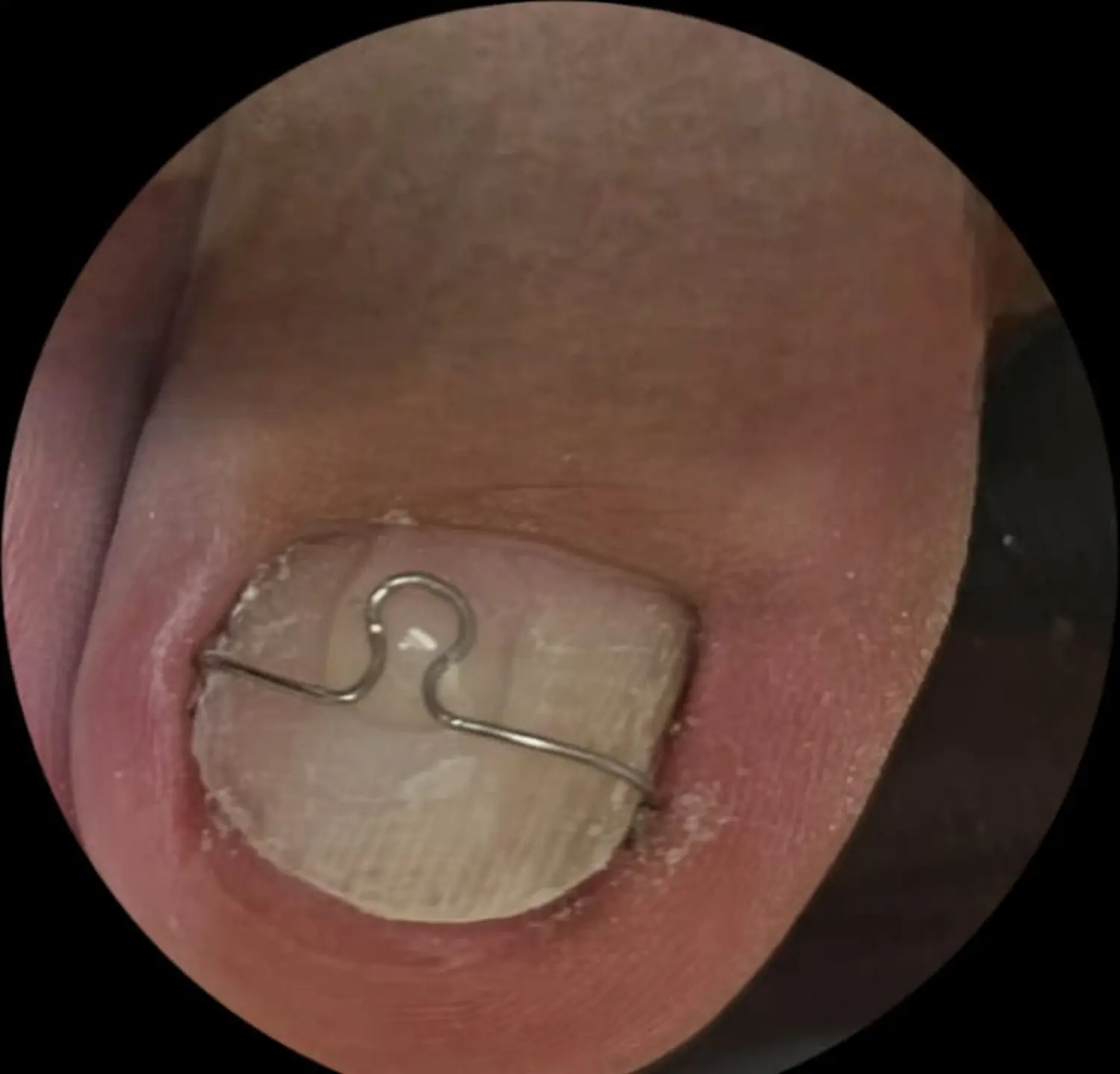 Podologie-Noa-toe mit ROSS-FRASER